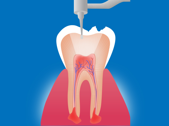 根管内の虫歯を取り除きます