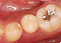 小臼歯・大臼歯クラウン（冠・被せ物）の治療費