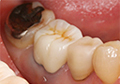 小臼歯・大臼歯クラウン（冠・被せ物）の治療費