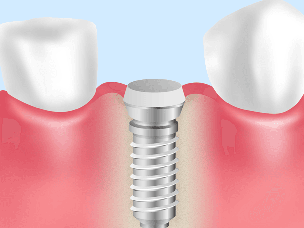人工歯根と人工歯をつなぐ部品を連結