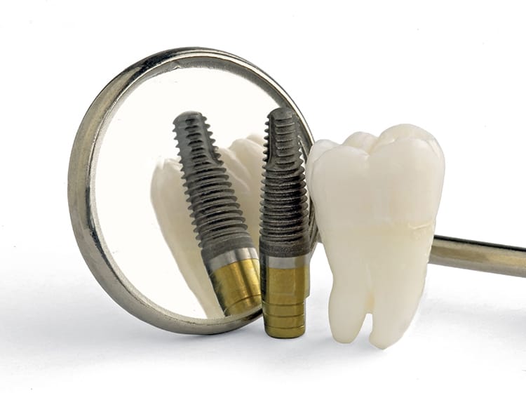 インプラントは虫歯になりませんが、歯周病にはなります