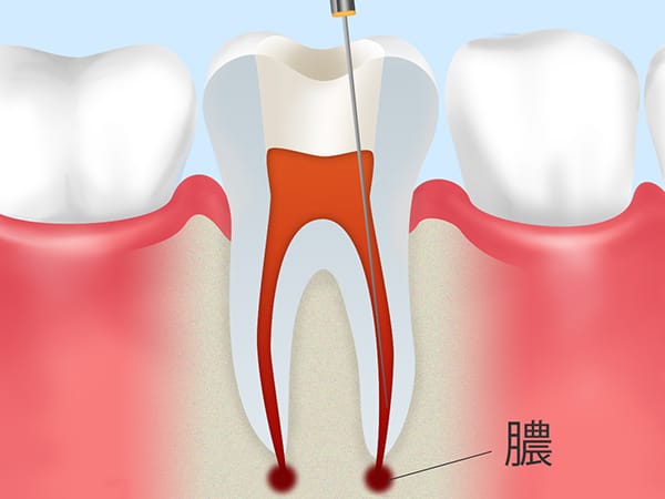 歯根嚢胞の症状